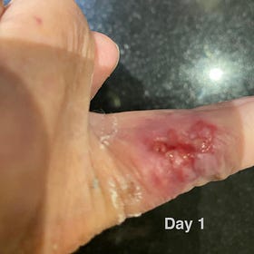 Case Report: Squamous Cell Carcinoma, age 80, Female 