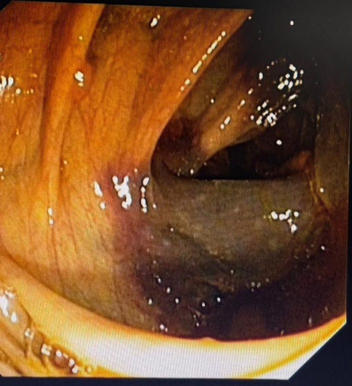 CASE 4: Hemorrhagic Ascending Colon — Ischemic Colitis on Anticoagulation