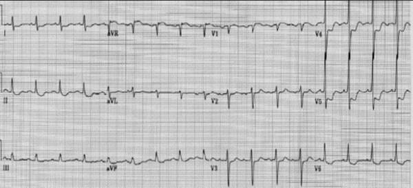 Image of a 12-lead transthoracic ECG