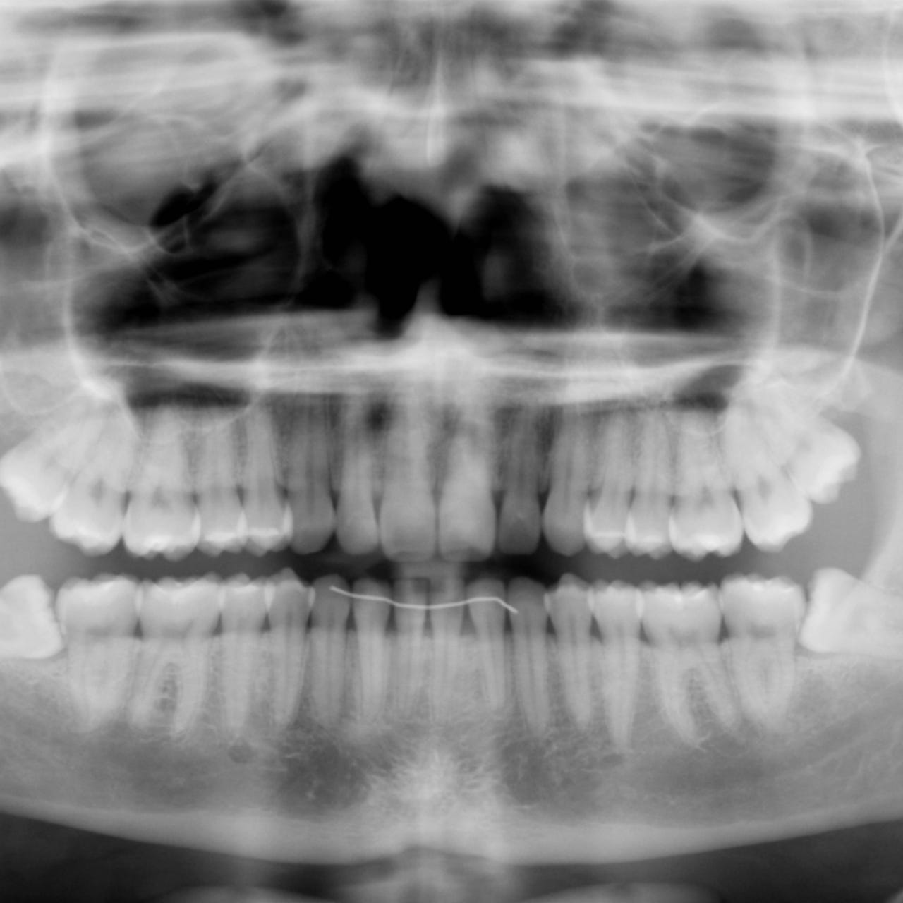 Brain Worms and Big Fish 