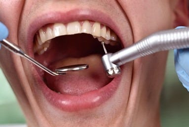 Dentist Using Dental Drill Mouth Mirror Stock Photo ... Dentist Using Dental Drill Mouth Mirror Stock Photo ...
