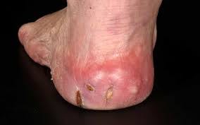 Diabetic Foot Ulcer