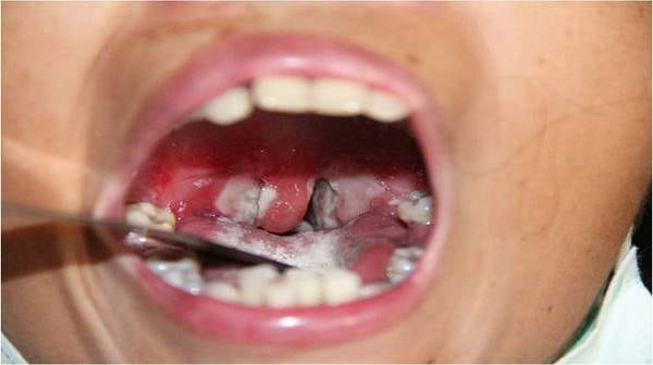 How to Avoid Getting Diphtheria