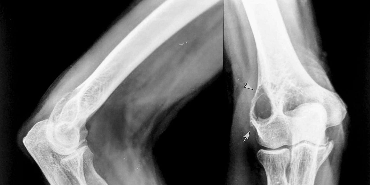 Case 69: In Every Patient Above the Age of 35, the Most Likely Cause of an Osteolytic Bone Lesions is... 