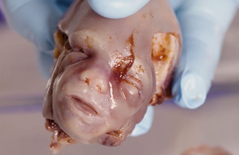 Abortion is Murder. Period.