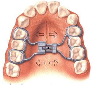 Correcting Crossbite with Palatal Expanders