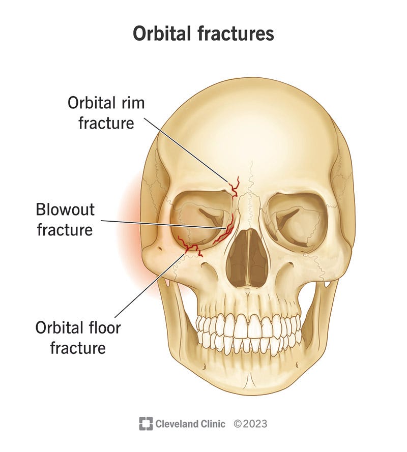 Orbital Fractures: Causes, Symptoms & Treatment