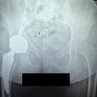 1 year since surgery