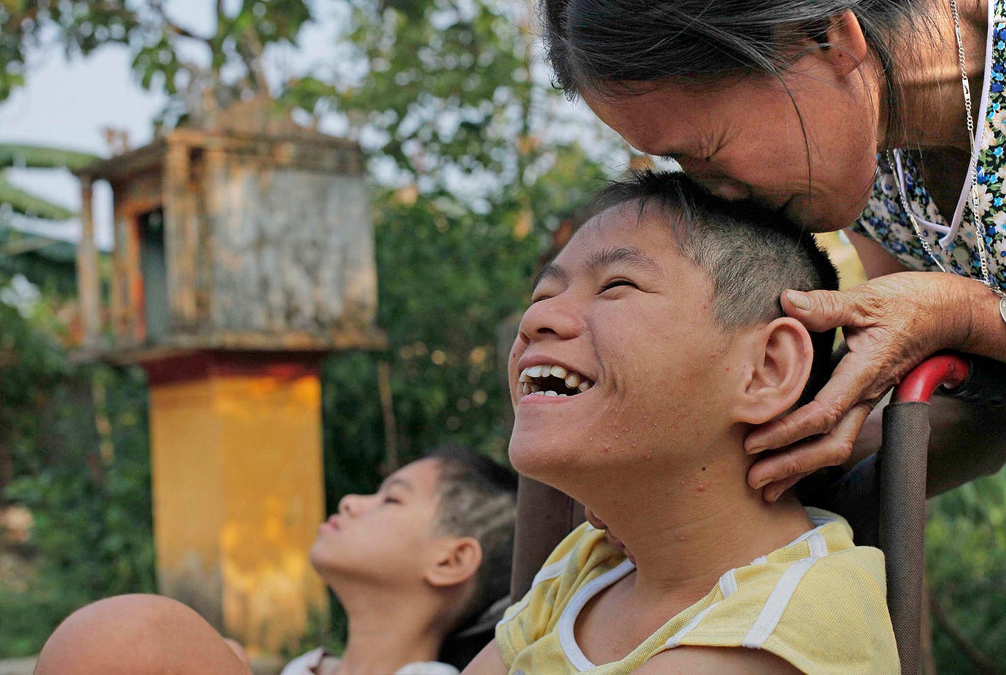 A woman with profound physical and mental disabilities attributed to Agent Orange is pictured on October 5, 2009, in Cam Tuyen, Vietnam. (Photo by David Guttenfelder/AP) A woman with profound physical and mental disabilities attributed to Agent Orange is pictured on October 5, 2009, in Cam Tuyen, Vietnam. (Photo by David Guttenfelder/AP)