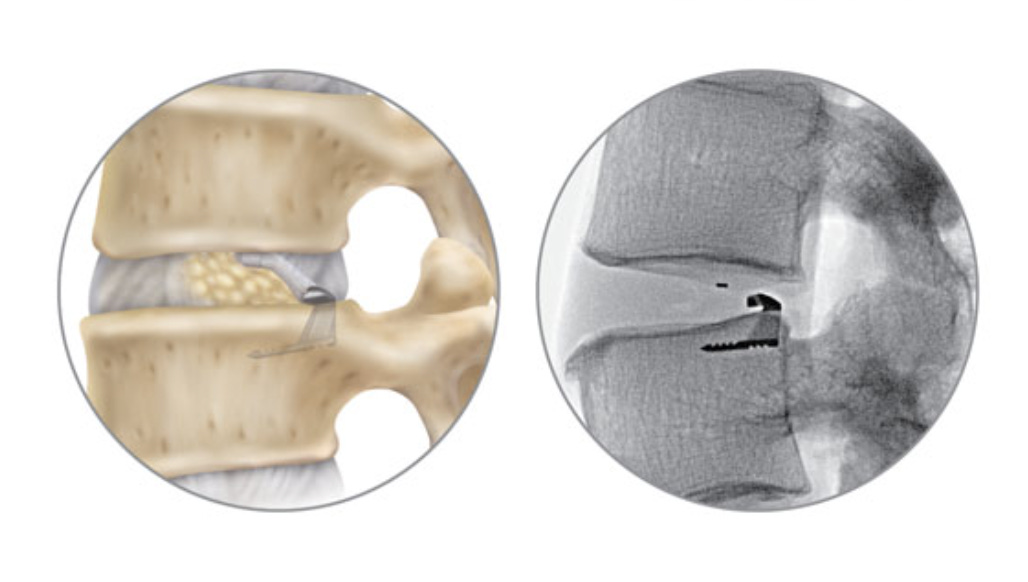 Barricaid – the band-aid for your spine!