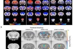 a. Brain structure comparisons of the following mice: Left: BTBR/R and B6 (normal mouse), Center: Comparison of BTBR/J and B6, Right: BTBR/J and BTBR/R. b. Diffusion tensor imaging to compare differences in nerve fibers. Red indicates the brain regions that were either bigger or had increased numbers of nerve fibers in BTBR/J mice in comparison to either B6 (left and center images) or BTBR/R (right image). Conversely, blue indicates brain regions in BTBR/J mice that were comparatively smaller or had decreased numbers of nerve fibers. These scans revealed particularly significant differences between BTBR/J and BTBR/R mice’s corpus callosum.