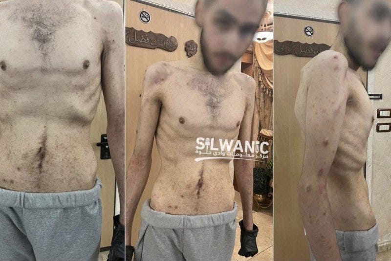 The Euro-Med Human Rights Monitor, after the fourth exchange of captives on Feb. 1, published photos of a Palestinian prisoner who appears severely emaciated. Photo courtesy of Euro-Med Human Rights Monitor