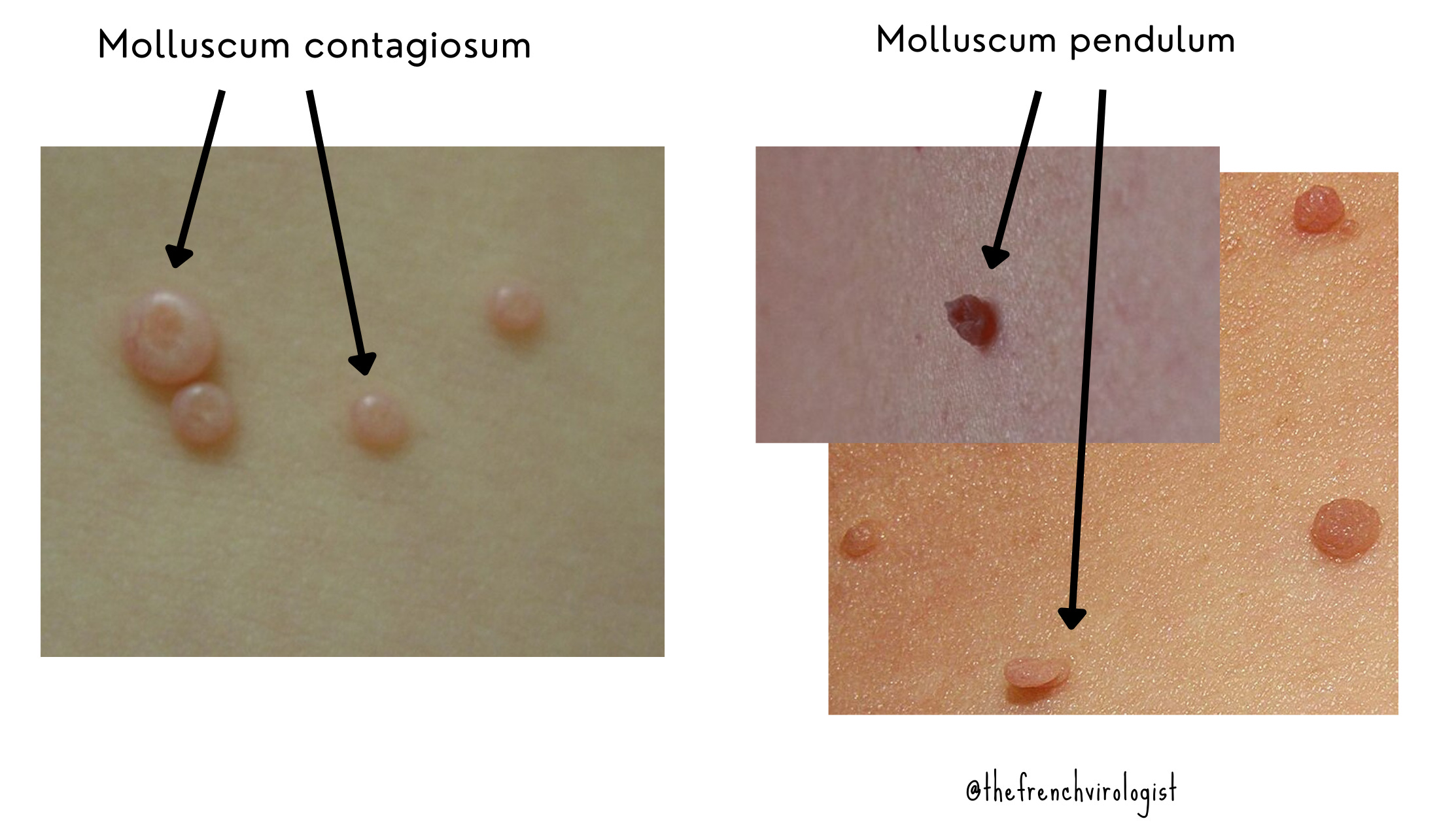 molluscum-contagiosum-comment-s-en-d-barrasser