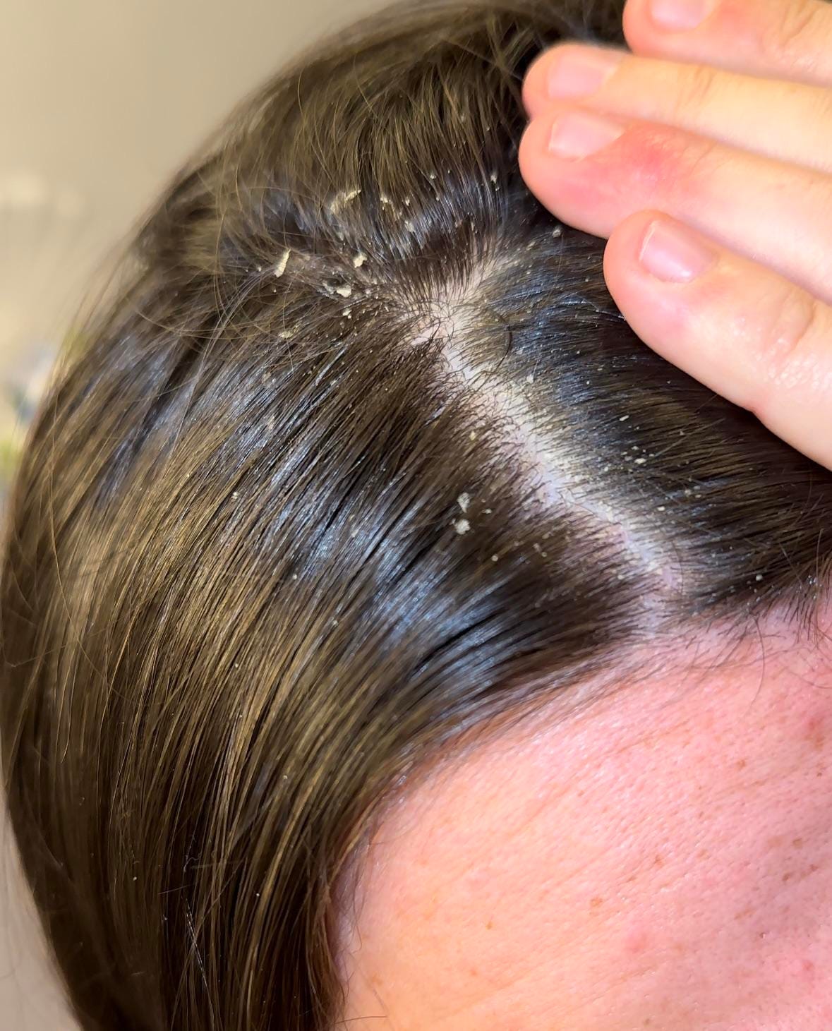 my hair feels like cotton after b12 injections The checklist for people who keep blaming stress B12 and Weight Loss: Size:5mg Does Not Contain_GMO