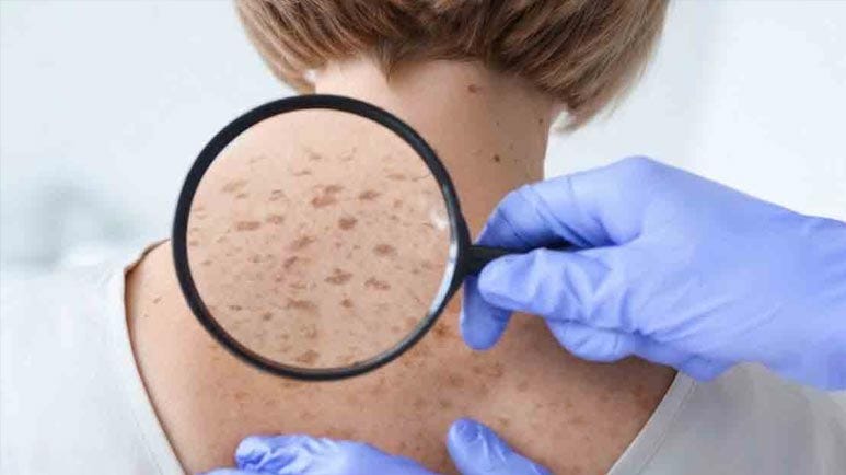 difference between sunspots and skin cancer difference between sunspots and skin cancer
