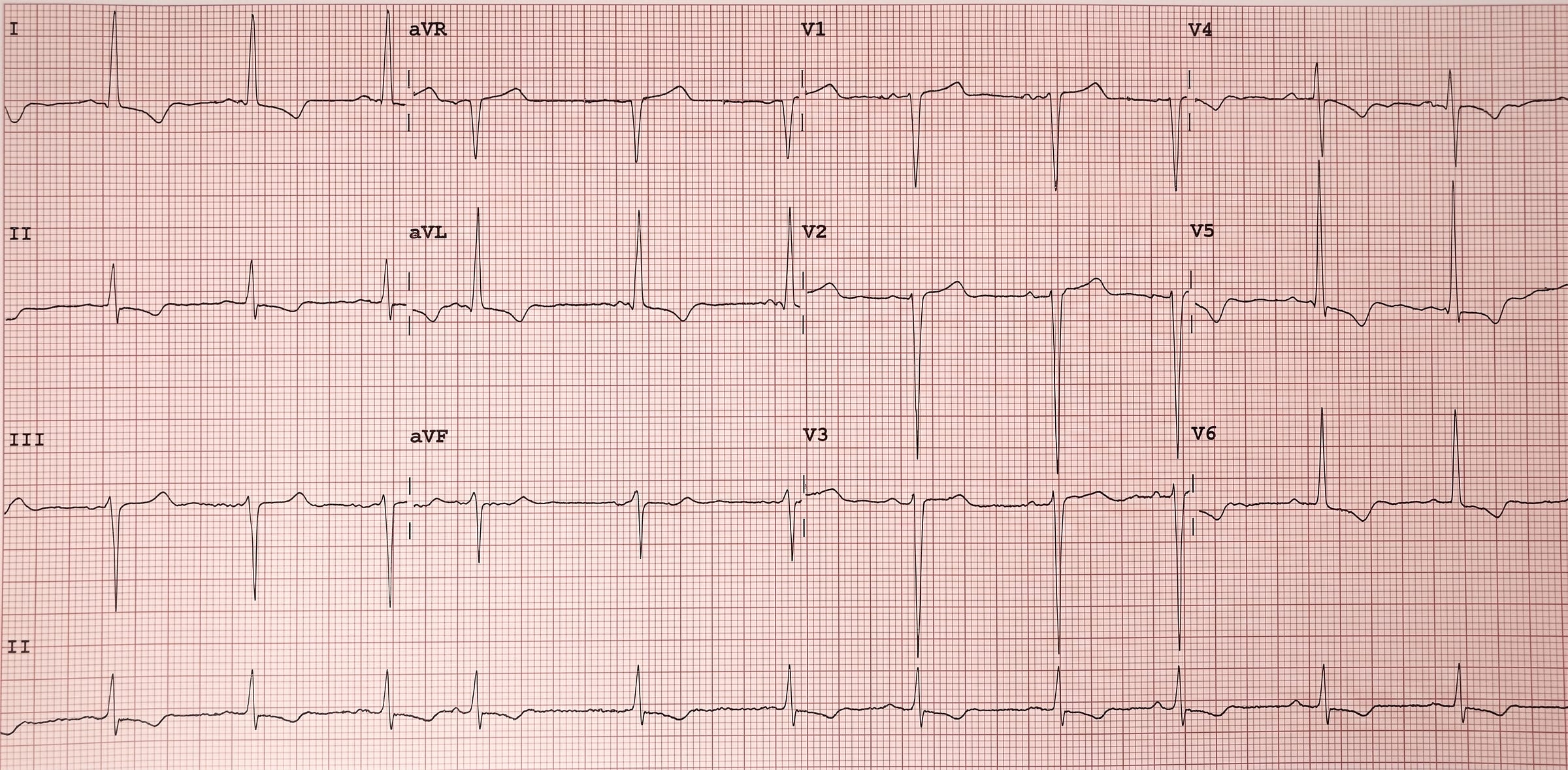 12-lead ECG recording 12-lead ECG recording