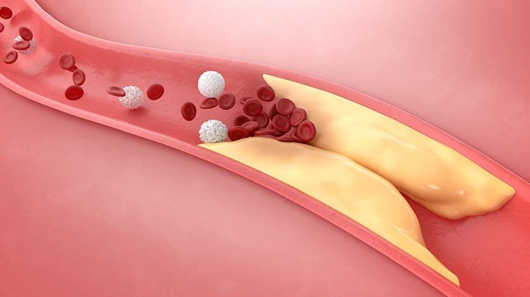 vitamins d3 and k2 coronary artery disease