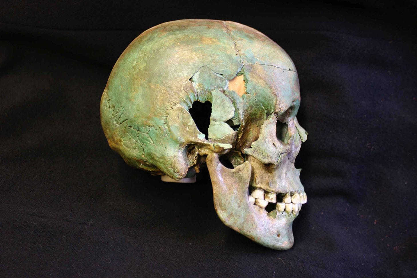 Human cranium with green coloration viewed from the right side