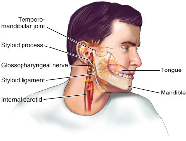 Eagle Syndrome | Anesthesia Key