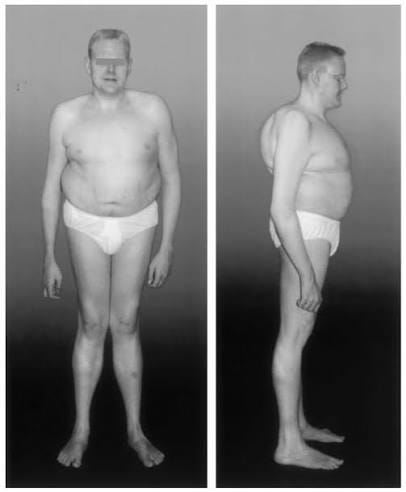 The 27-yr-old male with aromatase deficiency (with permission of the... | Download Scientific Diagram The 27-yr-old male with aromatase deficiency (with permission of the... | Download Scientific Diagram