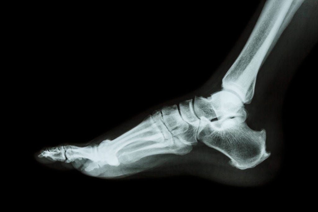 Everything You Need to Know About X-rays for Heel Pain | Heel That Pain