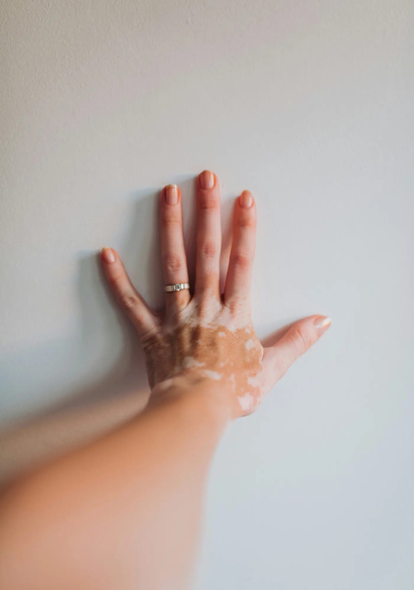 a hand with visual evidence of vitiligo depigmentation a hand with visual evidence of vitiligo depigmentation
