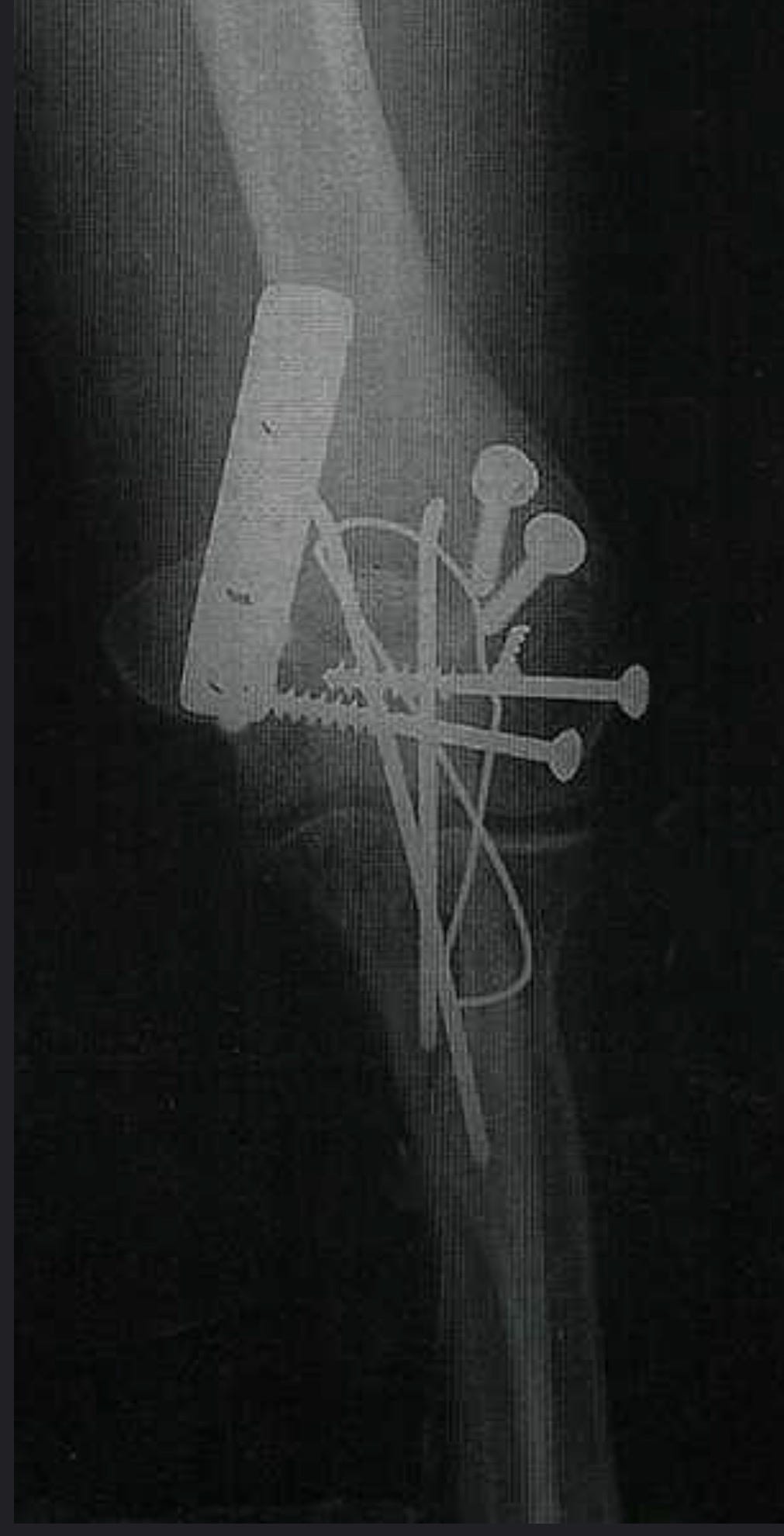 Black-and-white X-ray of a lower leg and ankle showing several long metal nails clustered around the bones. Black-and-white X-ray of a lower leg and ankle showing several long metal nails clustered around the bones.