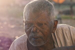 Man with scarred face. Pixabay