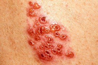 Health And Diseases Blog: Shingles