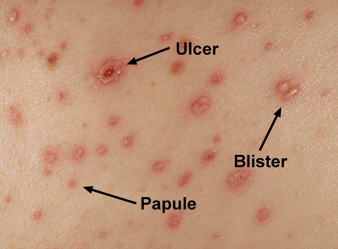 All About Chickenpox: How to Identify, Treat and Avoid It