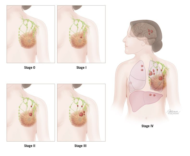 How does tumor size relate to breast cancer stage? CK Birla Hospital