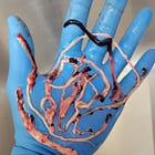 The Clots are Still Being Found - A Plea to Cath Lab Workers