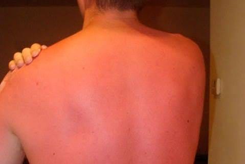 The Stages of a Sunburn | How a Sunburn Affects Your Skin