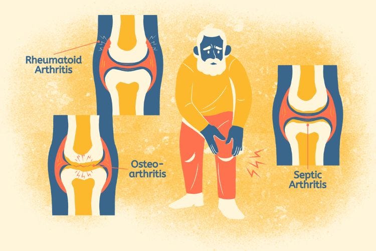 Arthritis