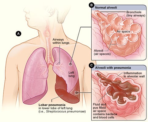 Pneumonia - What Is Pneumonia? | NHLBI, NIH Pneumonia - What Is Pneumonia? | NHLBI, NIH