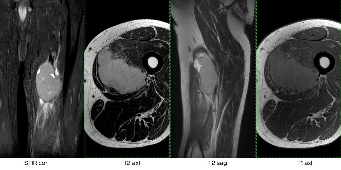 Case 21: A Growing Thigh Lesion