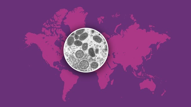 How do you test for monkeypox? What you need to know about mpox virus. How do you test for monkeypox? What you need to know about mpox virus.