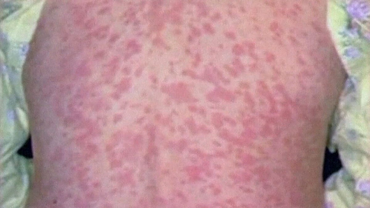 Rasonque Rash More Than a Rash: A Deeper Look at Why the Pennsylvania Measles ...