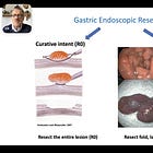 Upper Gl Resection Techniques: Stomach