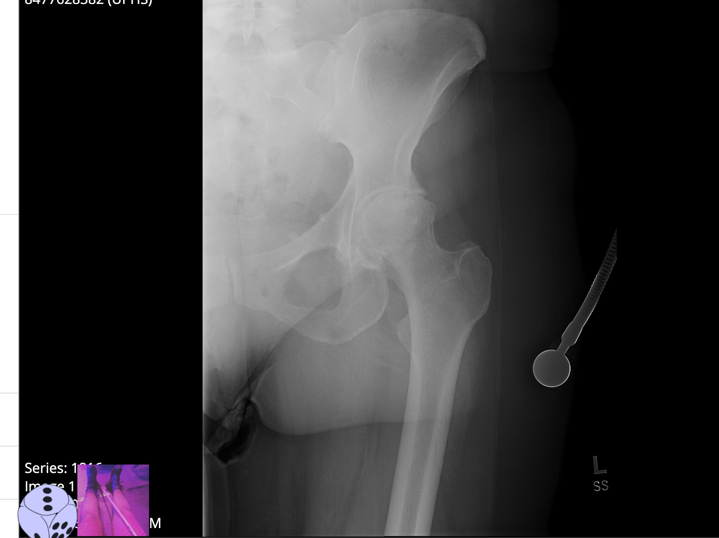 an x ray of the author's left hip bone