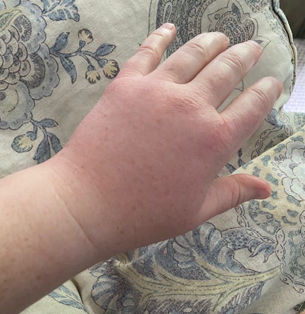 left hand swollen from bee stings left hand swollen from bee stings