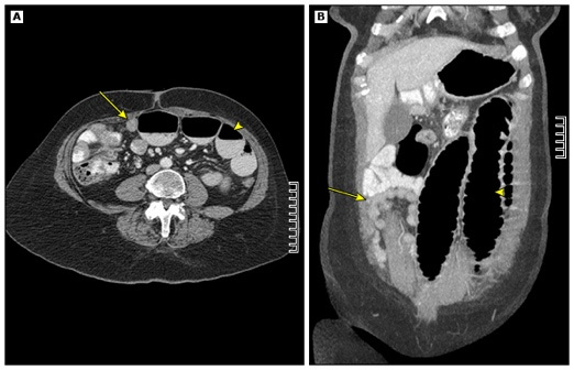 This is a diagnostic image titled Small bowel obstruction caused by metastatic ovarian carcinoma on CT scan. Legend: A CT scan of the abdomen (A) shows dilated upstream small bowel (arrowhead). The downstream small bowel is decompressed (arrow). Image B is a coronal reconstruction of the CT and shows dilated upstream small bowel (arrowhead). The downstream small bowel is decompressed (arrow).