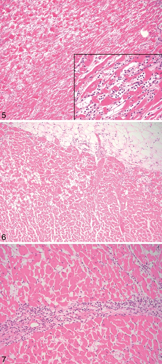 Case B, heart: hypereosinophilic myocytes, contraction band necrosis, and coagulative myocytolysis. Inset: the infiltrate is predominantly neutrophilic (hematoxylin-eosin, original magnifications ×100 and ×400 [inset]).