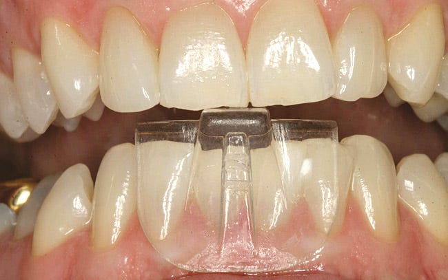 A Clinician's Guide to Occlusal Splint Therapy | VISTAS Complete and  Predictable Dentistry