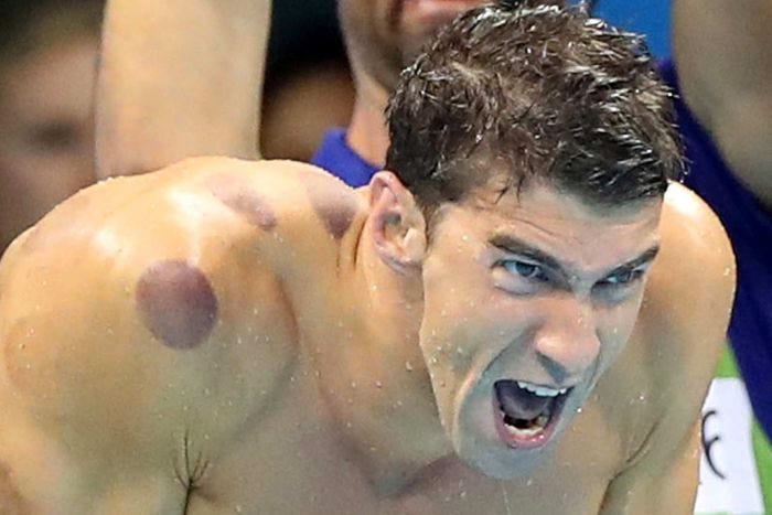 michael phelps shows cupping works michael phelps shows cupping works