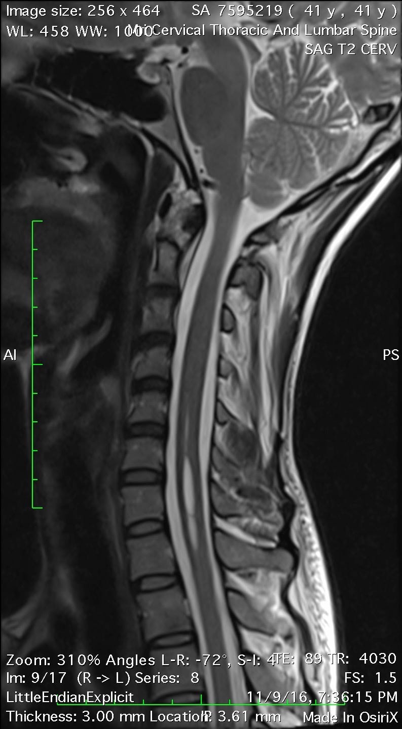 MRI slice of my spinal cord showing as cavity in the cervical region; it is actually a fluid filled cyst called a syrinx.