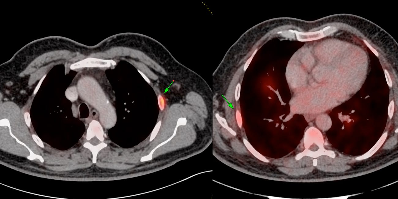 Case 60: The Pitfalls of Rib Uptake on PSMA PET