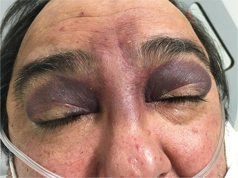 Raccoon sign | Neurology perspectives Raccoon sign | Neurology perspectives