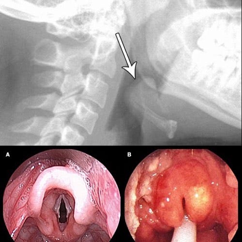 On the left are vocal cords and  a normal epiglottis (A) - the cartilage flap that folds over our windpipe or trachea when we eat or drink something and opens when we breathe. On the right (B) is the classic cherry red epiglottis that you see in a child with epiglottitis. And on top in the ‘thumb sign’ you might see on an xray - that’s the swollen epiglottis!