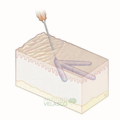 aplicação em Leque aplicação em Leque